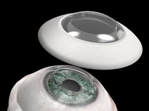 Una cornea artificiale per riottenere la vista