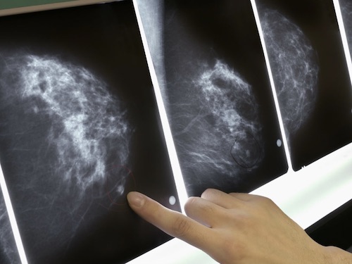 L’IA di Google per prevenire il cancro al seno